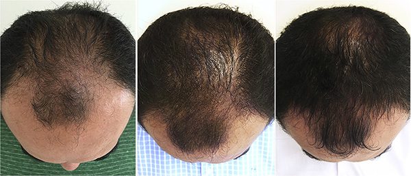 عوارض مزوتراپی مو چیست