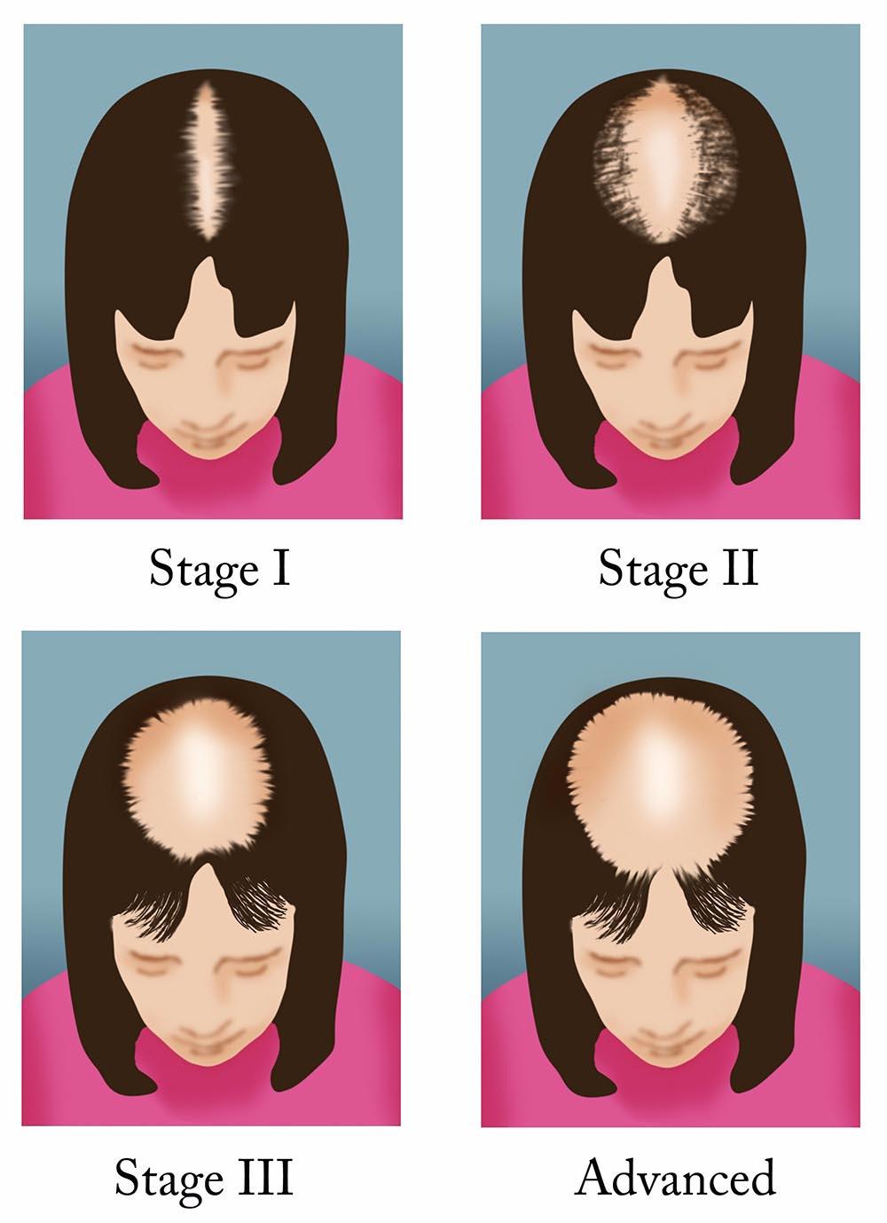 مراحل ریزش مو الگوی زنانه