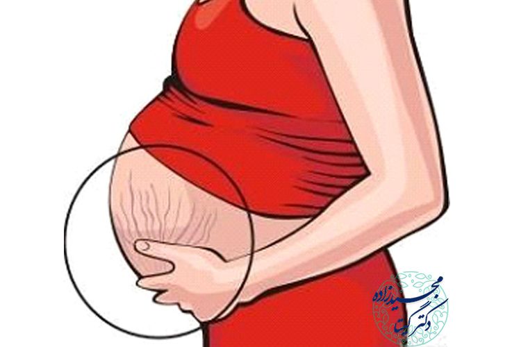 علل ایجاد خطوط حاملگی