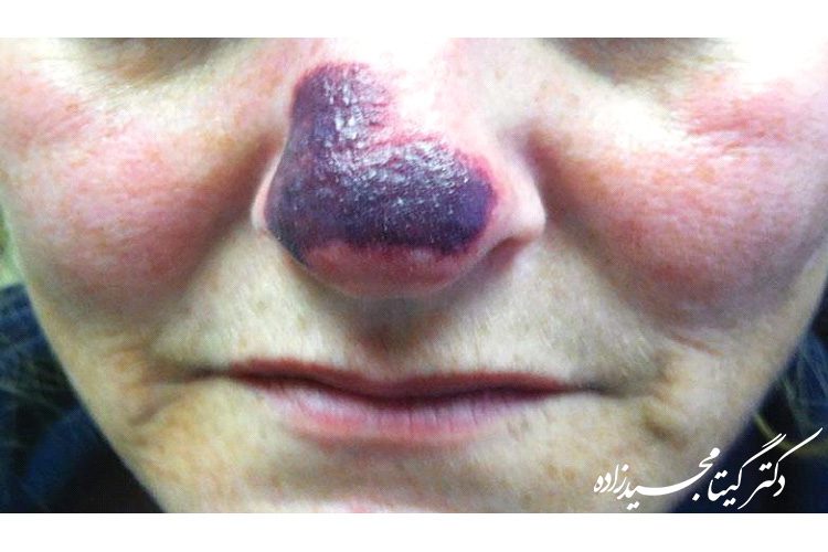 سیاه شدن پوست بینی بعد از عمل