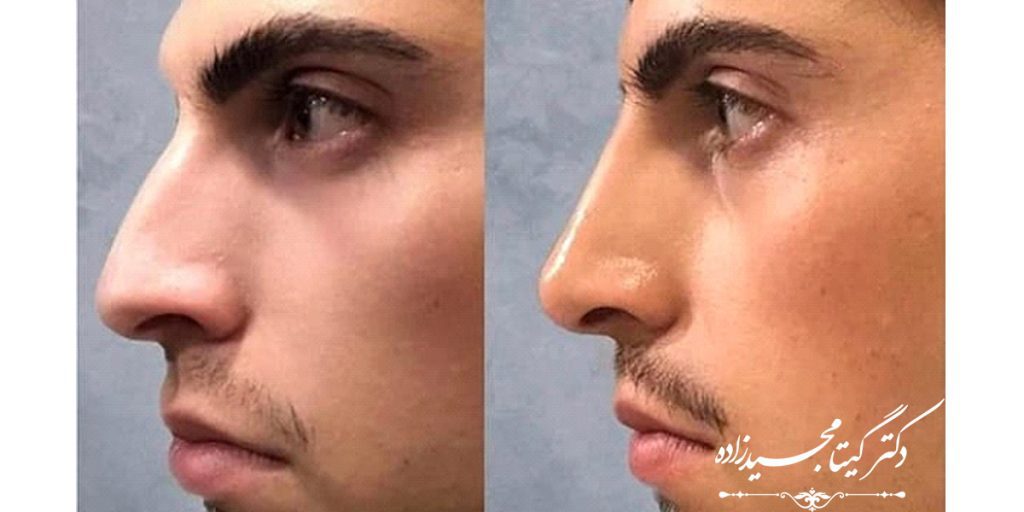 تزریق بوتاکس قبل و بعد از عمل بینی