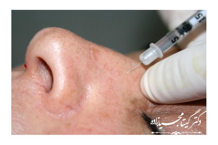 تزریق بوتاکس قبل از عمل بینی