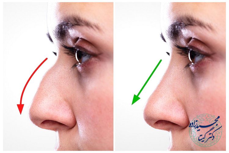 علت نبض زدن بینی بعد از عمل